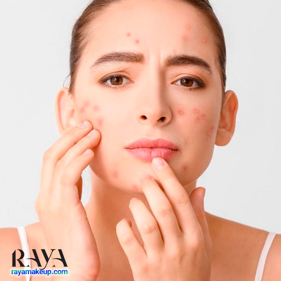 آیا دست زدن به پوست صورت باعث ایجاد جوش و آکنه می شود؟ 