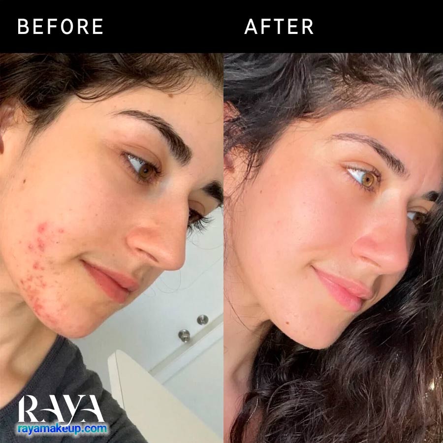 کرم ضد جوش سوکسینیک اسید اینکی لیست The Inkey List Succinic Acid Treatment