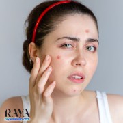 معرفی بهترین گیاهان دارویی برای جوش و آکنه