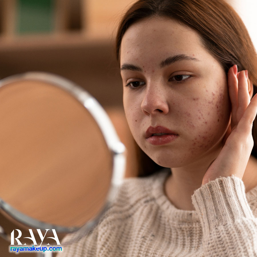 بررسی عملکرد ترتینوئین برای درمان جوش و آکنه 