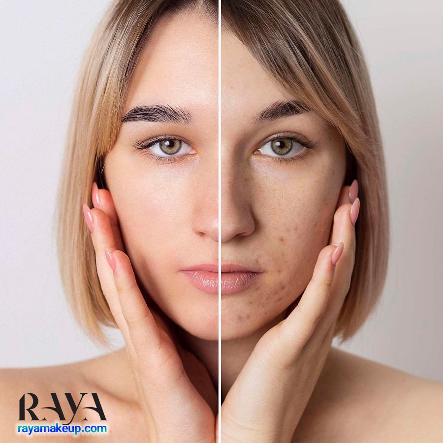 بررسی عملکرد ترتینوئین برای درمان جوش و آکنه 	