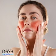 چگونه روزاسه و قرمزی پوست را در خانه درمان کنیم؟ 