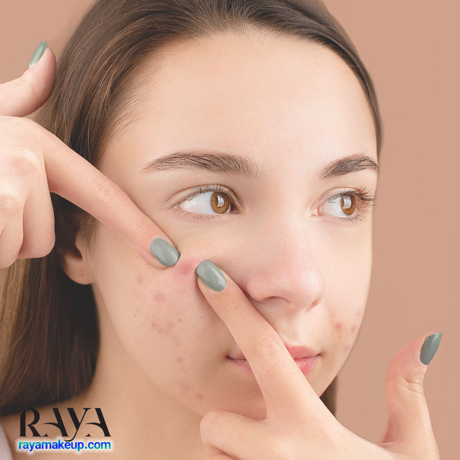 چرا پوست های خشک، جوش می زنند؟ همراه با 14 روش درمان خانگی