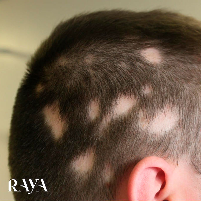 علائم ریزش موی سکه ای و درمان آن