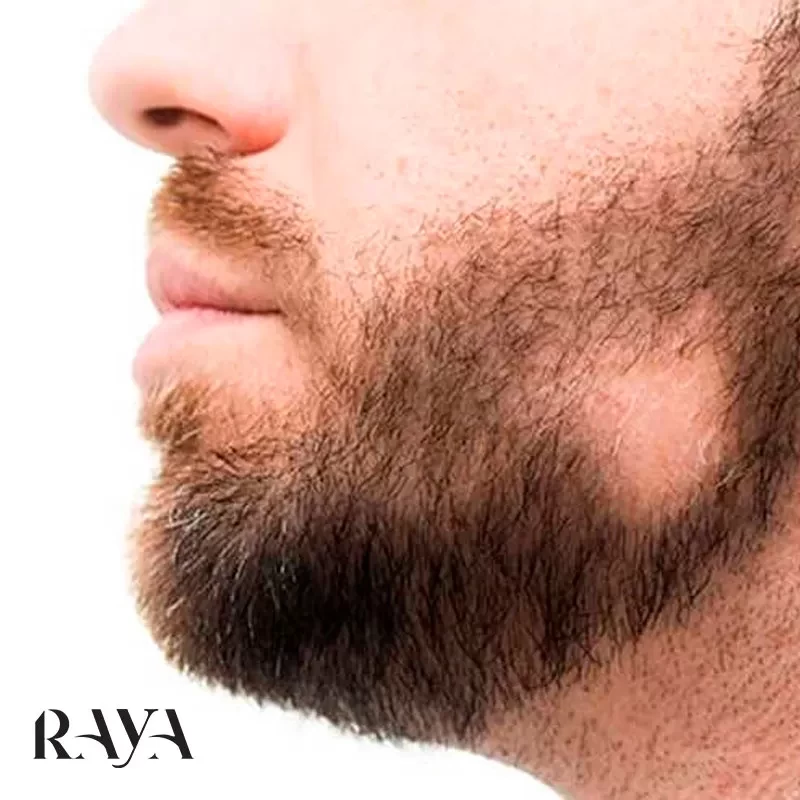 علائم ریزش موی سکه ای و درمان آن